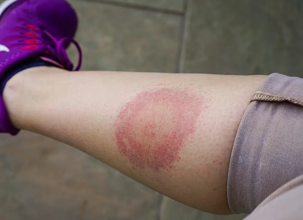 A lower leg is shown, with the pants cuff rolled up. On the calf is a large, red, circular rash resembling a target.