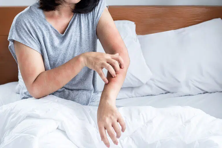 A closeup of a woman sitting in bed scratching a rash on her arm.