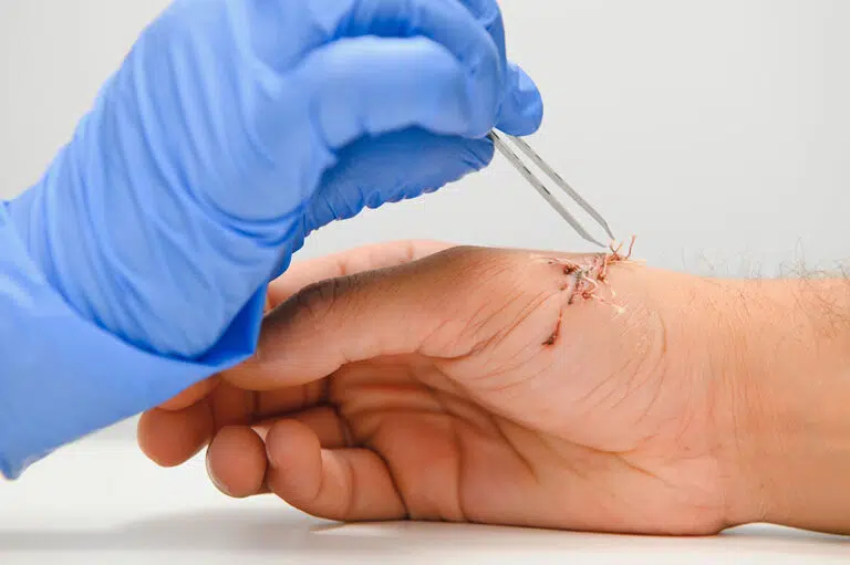 Close up of doctor putting stitches in mans hand